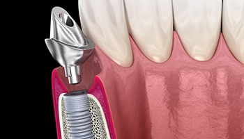 A 3D illustration of a dental implant abutment