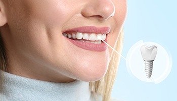 A photo highlighting a woman’s complete dental implant