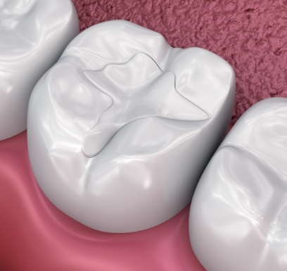 Animated smile with dental sealants