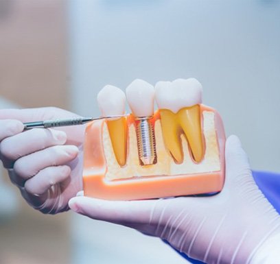 a dentist presenting a model of a dental implant