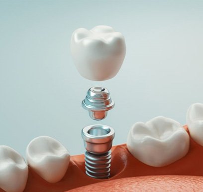 a 3 D example of a single dental implant