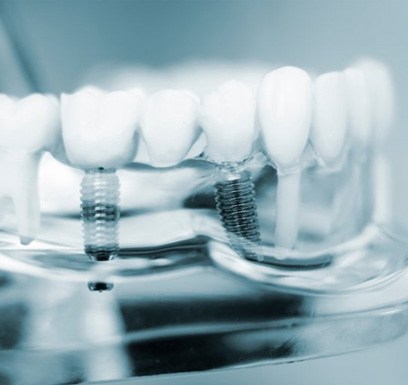 a plastic model of dental implant bridges