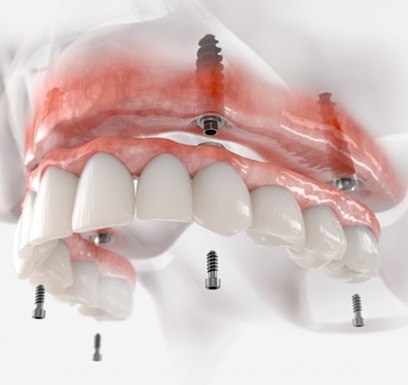 a 3 D illustration of implant dentures