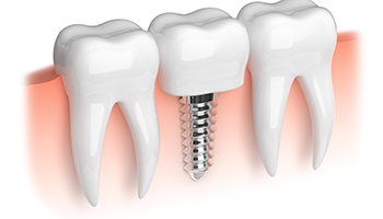 Illustration of dental implant between two natural teeth