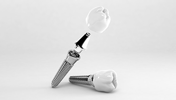 Illustration of two dental implants with one having crown and abutment attached