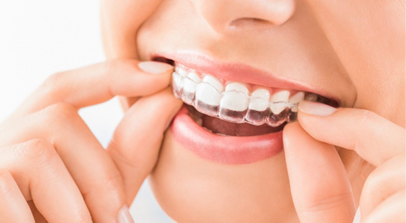 Invisalign® in Tulsa 