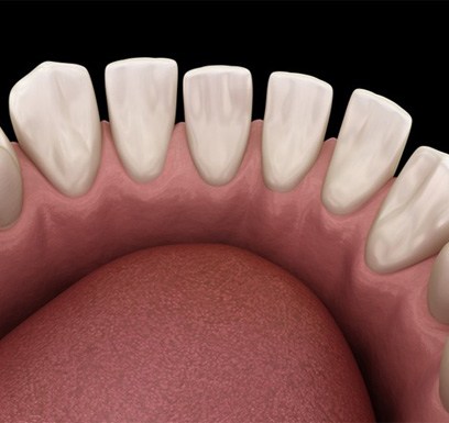 : a 3 D illustration of gapped teeth