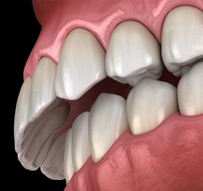 : a 3 D illustration of an overbite