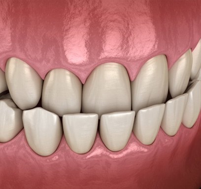 a 3 D illustration of an underbite