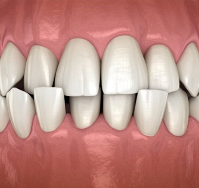 aa 3 D illustration of a crossbite