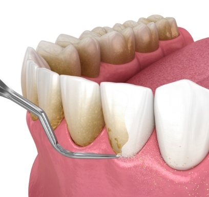 Animated smile during scaling and root planing treatment