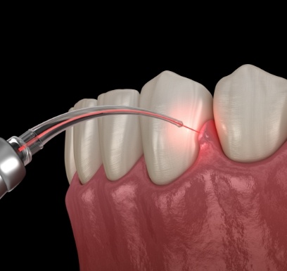 Animated smile during laser periodontal therapy