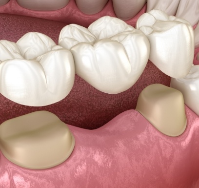 Animated smile during dental bridge placement