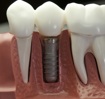 Model smile with dental implant supported dental crown