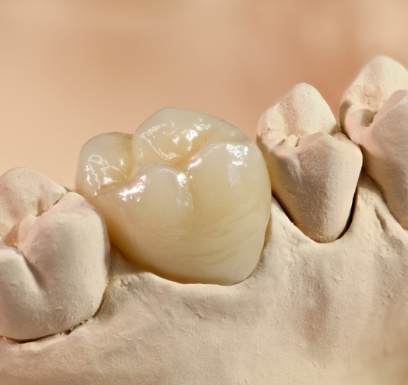 Model smile with dental crown restoration