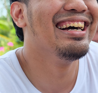 Up-close image of man’s stained teeth