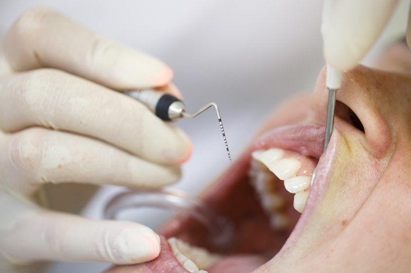 Periodontal therapy, a procedure often done before getting dental implants